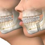 ببینید | مراحل انجام جراحی فک چگونه است؟