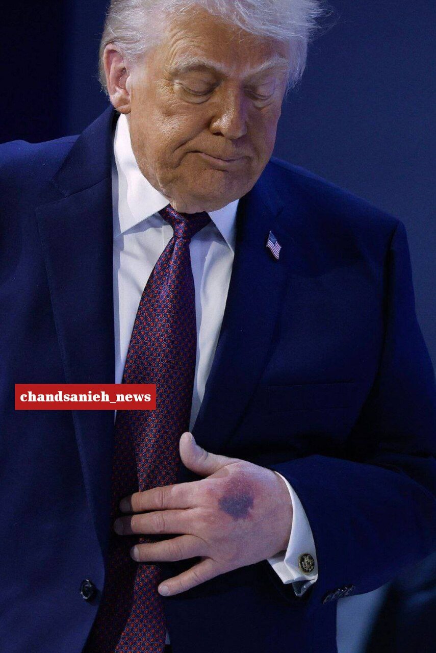 ببینید | تصویری خبرساز از وضعیت عجیب دست دونالد ترامپ
