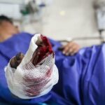 ببینید |  لحظه انفجار نارنجک دست‌ساز در دستان یک جوان در تبریز